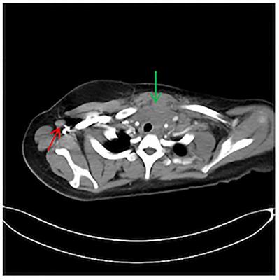 Paraneoplastic dermatomyositis and Hodgkin’s lymphoma in a 14-year-old girl: a case report and literature review